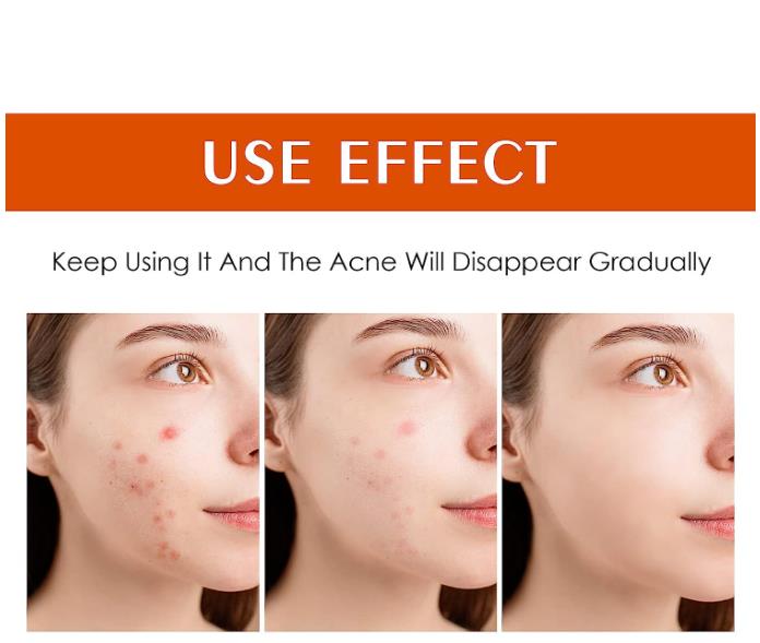 AHA 30% + BHA 2% Peeling Solutions, 30% AHA Glycolic Acid Peel with ...